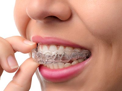 The Center for Advanced Dental Care, PLLC | Fluoride Treatment, TMJ Disorders and Veneers
