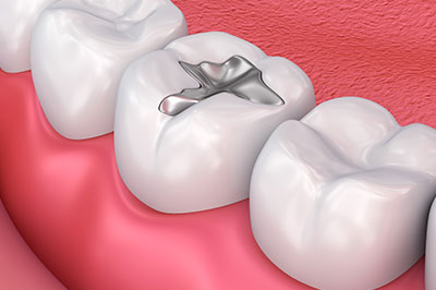 The Center for Advanced Dental Care, PLLC | Dental Fillings, Digital Radiography and Periodontal Treatment