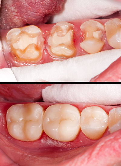 The Center for Advanced Dental Care, PLLC | Veneers, Inlays  amp  Onlays and Implant Dentistry