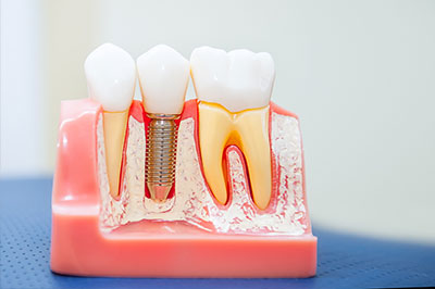 The Center for Advanced Dental Care, PLLC | Dental Sealants, TMJ Disorders and CBCT