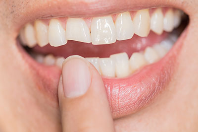 The Center for Advanced Dental Care, PLLC | Oral Cancer Screening, Night Guards and Teeth Whitening