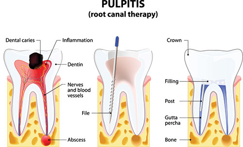 The Center for Advanced Dental Care, PLLC | Inlays  amp  Onlays, Intraoral Camera and Veneers