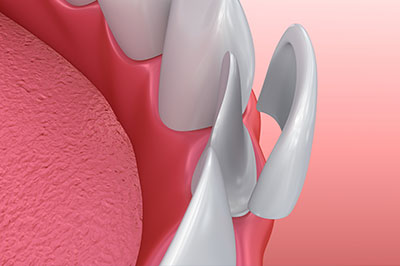 The Center for Advanced Dental Care, PLLC | TMJ Disorders, Teeth Whitening and Preventative Program