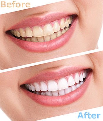 The Center for Advanced Dental Care, PLLC | CEREC, Full Mouth Reconstruction and Intraoral Camera